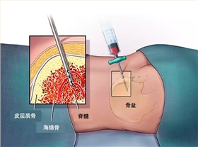 穿刺針沖壓廠家